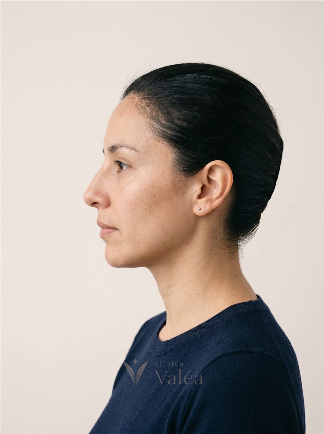 Perfil nasal, antes